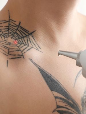 DIANA M - ELIMINAR TATUAJES