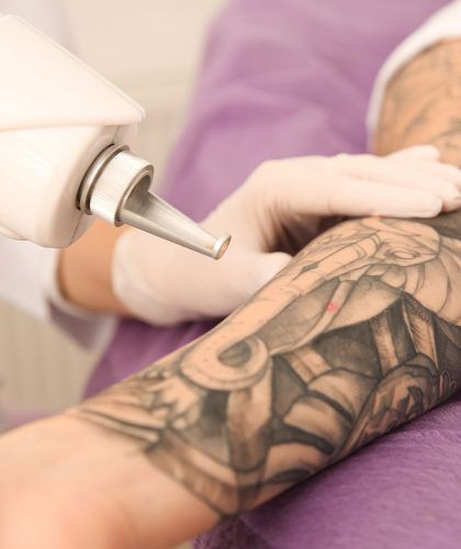 Eliminación de tatuajes